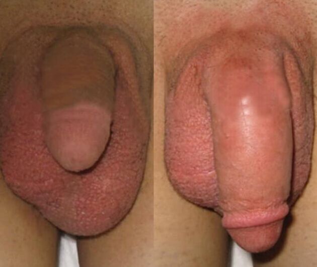 The result of installing a collagen matrix in the penis