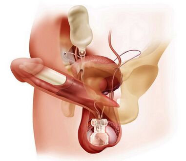 surgical penis enlargement
